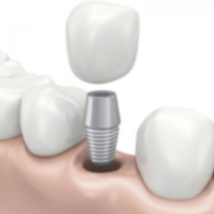 dental implant