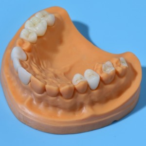All-ceramic teeth